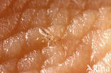 Body Louse (Pediculus humanus)