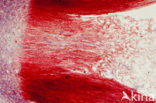 Moederkoren (Claviceps purpurea)